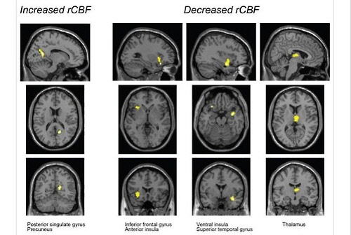 목에 충격 주면 뇌 특정 부위 기능에 영향 목에 전기자극을 주면 뇌 통증과 감각처리 등 관련 부위의 혈류가 변화하고 결국 관련 뇌 기능에 이상이 생길 수 있음을 보여주는 뇌 영상 촬영 사진. [온라인 학술지 이바이오메디신(EBioMedicine)의 논문 캡처]
